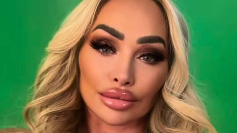 Stacey Silva razkazuje rezultate najnovejšega kozmetičnega tretmaja: 'Pripravljena sem na poljub'