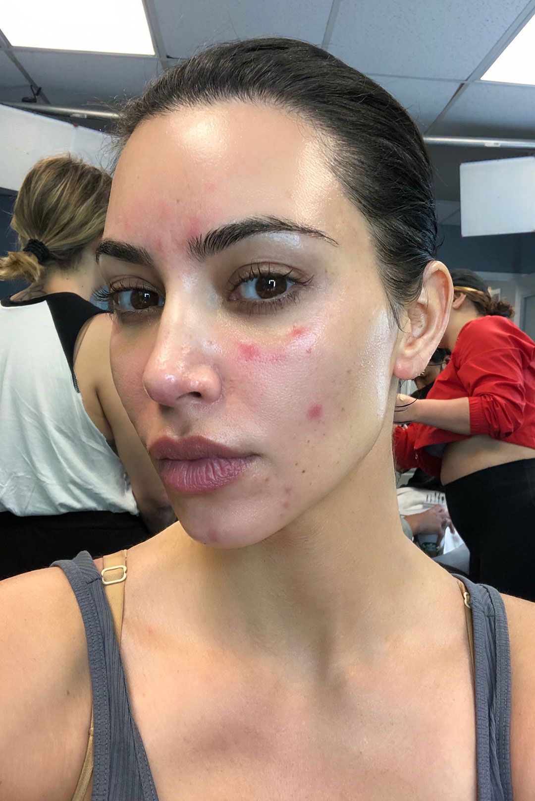 Kim Kardashian Psoriasis
